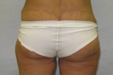 after lower body lift female patient back view case 7562