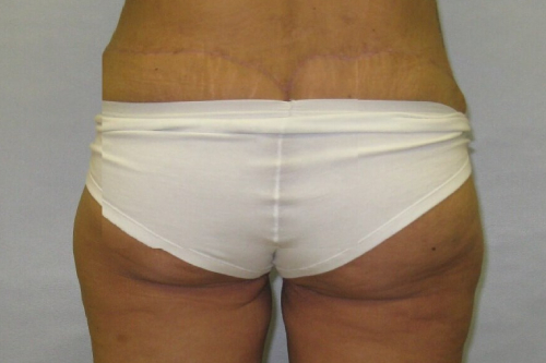 after lower body lift female patient back view case 7562