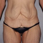 before lower body lift female patient front view case 7543