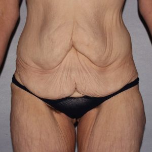 before lower body lift female patient front view case 7543