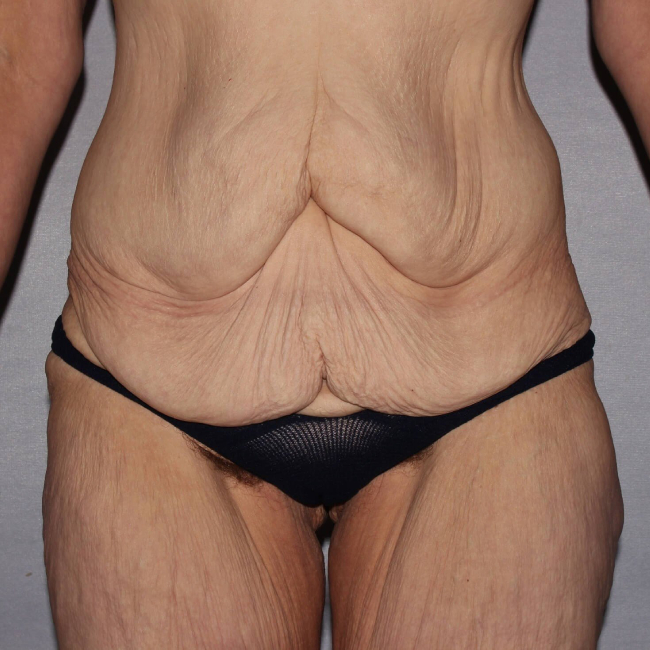 before lower body lift female patient front view case 7543