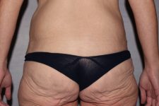before lower body lift female patient back view case 7543