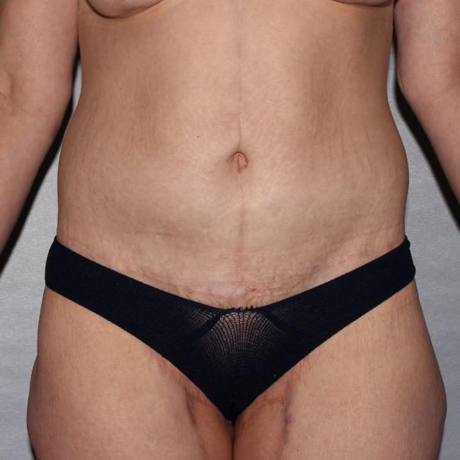 after lower body lift female patient front view case 7543