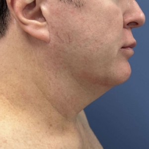 image before myellevate jawline contour - male patient right angle case 6464