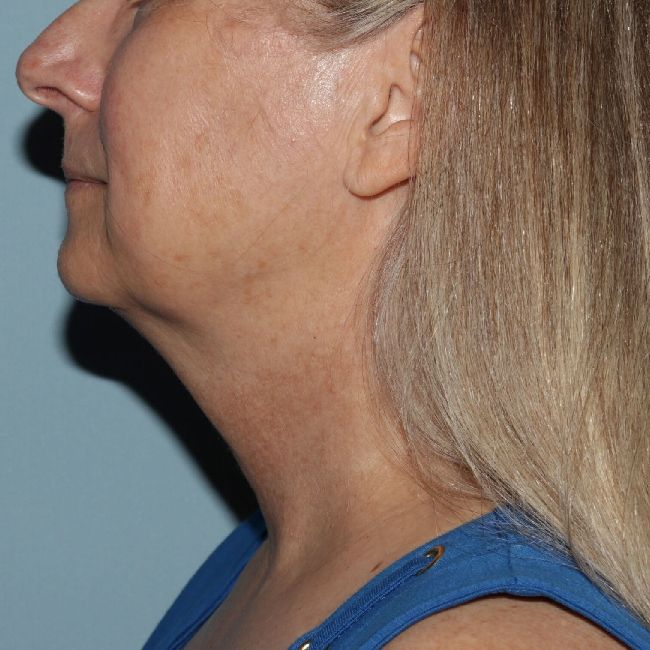 image before myellevate - zoom lift left angle case 6443