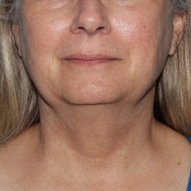 image before myellevate - zoom lift front view case 6443