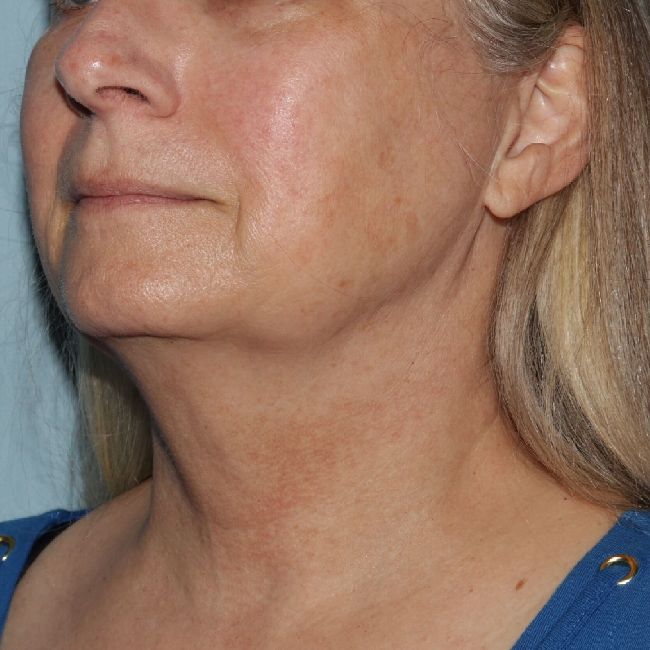 image before myellevate - zoom lift 45 degrees left angle case 6443