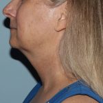 image before myellevate - zoom lift left angle case 6443