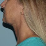 image after myellevate - zoom lift left angle case 6443