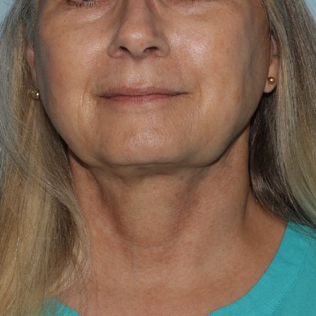 image after myellevate - zoom lift 45 degrees front view case 6443