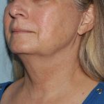 image before myellevate - zoom lift 45 degrees left angle case 6443