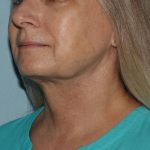 image after myellevate - zoom lift 45 degrees left angle case 6443