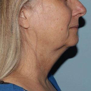 image before myellevate - zoom lift right angle case 6443