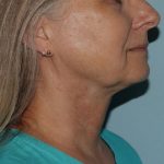 image after myellevate - zoom lift right angle case 6443