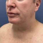 image before myellevate jawline contour - male patient 45 degrees left angle case 6464
