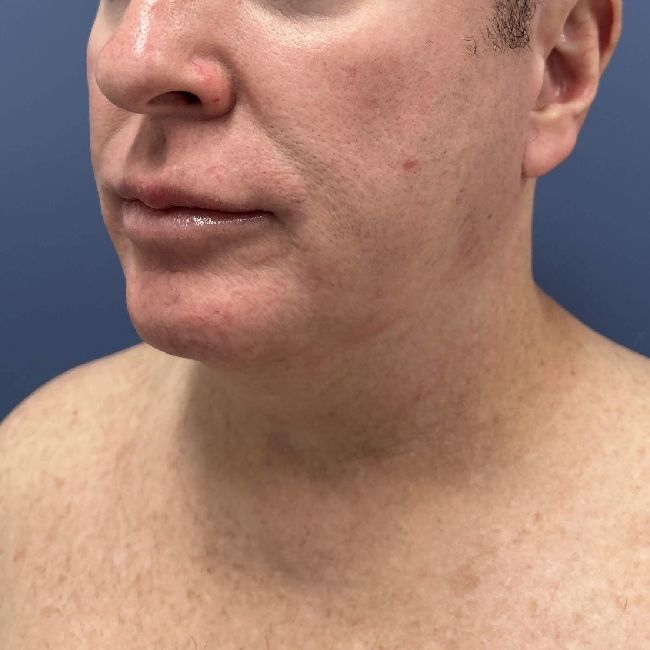 image before myellevate jawline contour - male patient 45 degrees left angle case 6464