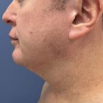 image before myellevate jawline contour - male patient left angle case 6464