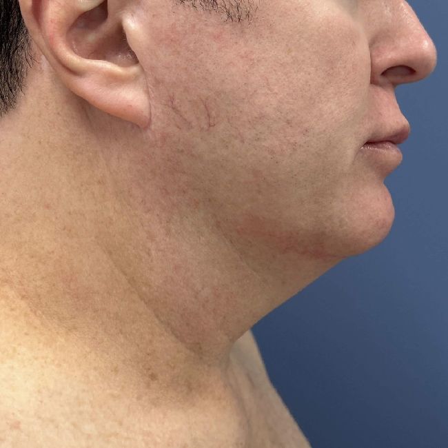 image before myellevate jawline contour - male patient right angle case 6464
