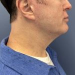 image after myellevate jawline contour - male patient angle case 6464