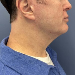 image after myellevate jawline contour - male patient angle case 6464