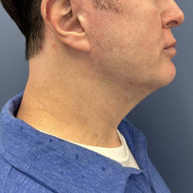 image after myellevate jawline contour - male patient angle case 6464