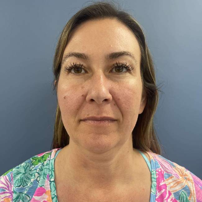 before myellevate front view case 6621