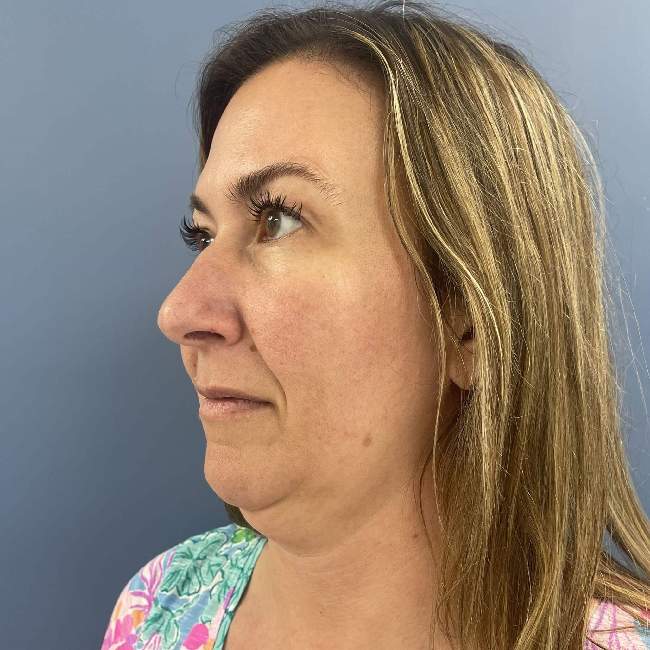 before myellevate 45 degrees left angle case 6621