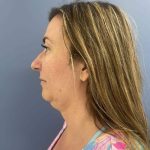 before myellevate left angle case 6621