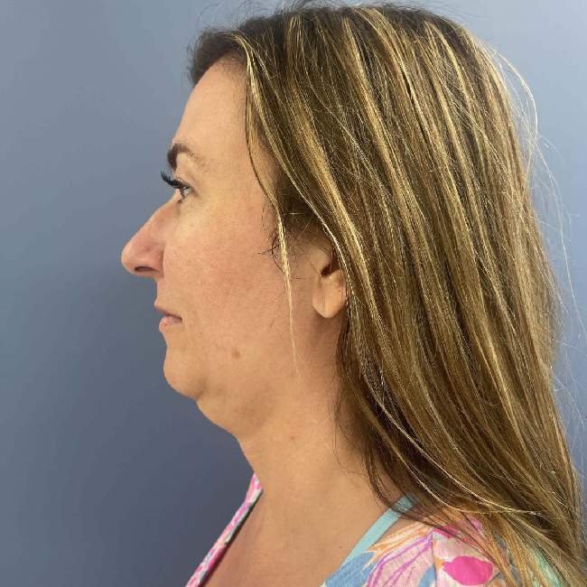 before myellevate left angle case 6621