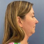 before myellevate right angle case 6621