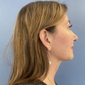 after myellevate right angle case 6621