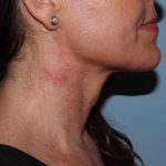 image after myellevate - minimally invasive neck lift right angle case 6650