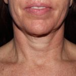 image before myellevate - minimally invasive neck lift front view case 6650