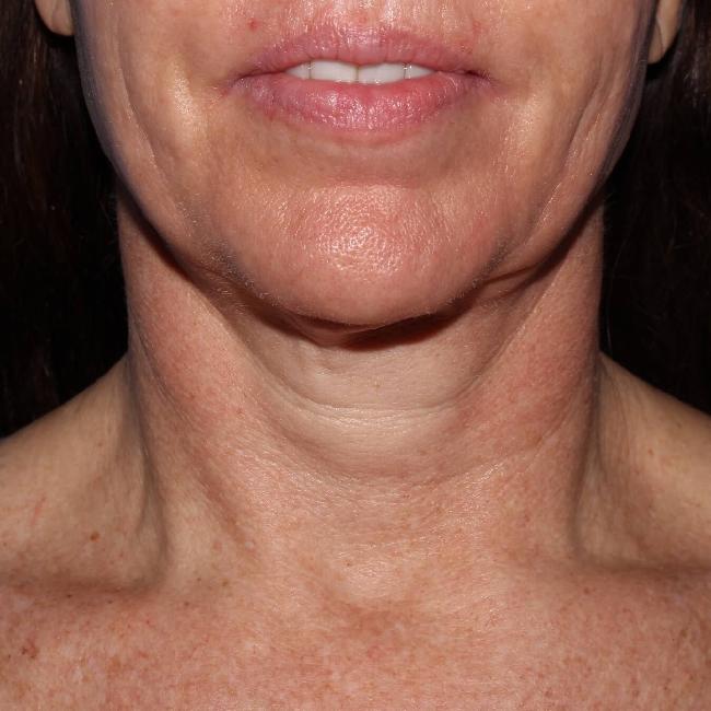image before myellevate - minimally invasive neck lift front view case 6650