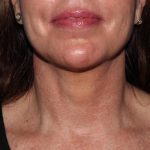 image after myellevate - minimally invasive neck lift front view case 6650