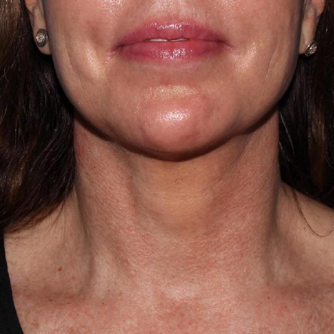 image after myellevate - minimally invasive neck lift front view case 6650
