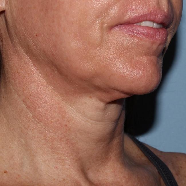image before myellevate - minimally invasive neck lift 45 degrees right angle case 6650