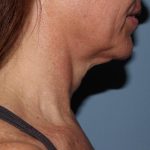 image before myellevate - minimally invasive neck lift right angle case 6650