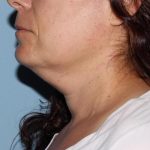 image before myellevate - zoom lift left angle case 6680