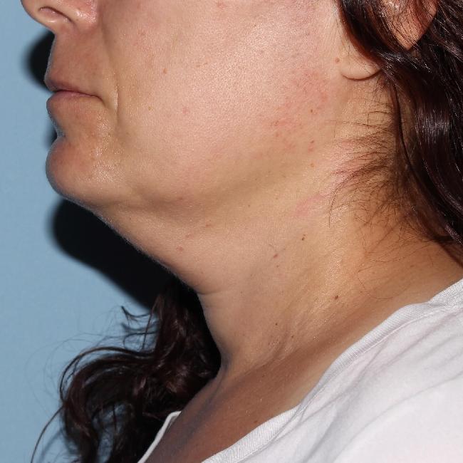 image before myellevate - zoom lift left angle case 6680