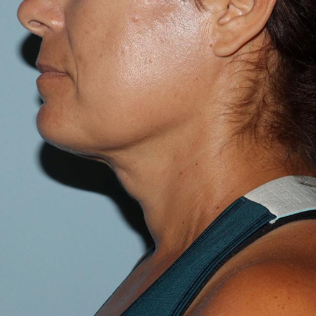 image after myellevate - zoom lift left angle case 6680