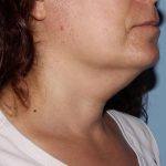 image before myellevate - zoom lift right angle case 6680