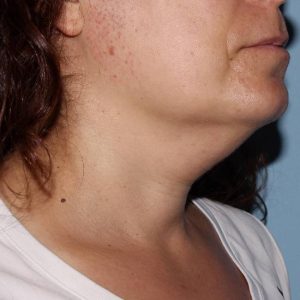 image before myellevate - zoom lift right angle case 6680