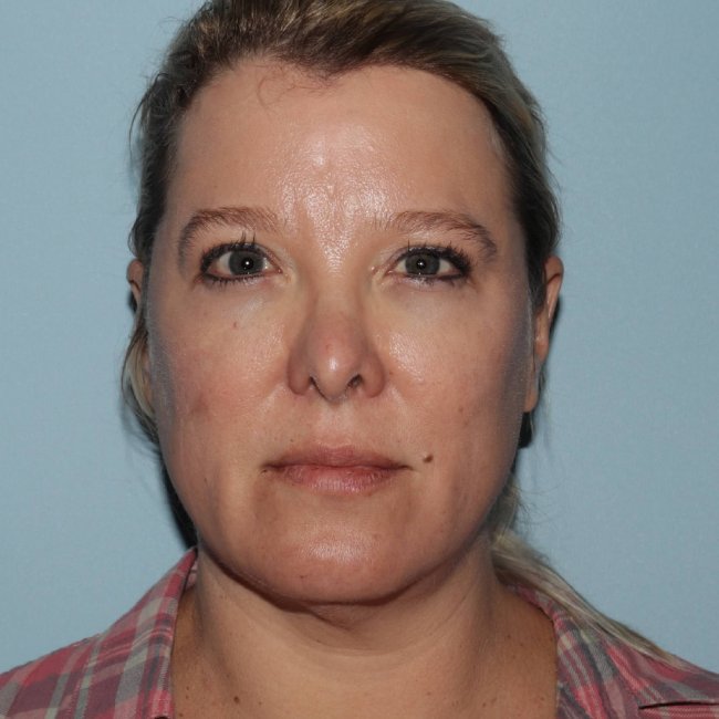 image before myellevate - zoom lift minimally invasive neck lift front view case 7202