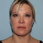 image after myellevate - zoom lift minimally invasive neck lift front view case 7202