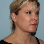 image after myellevate - zoom lift minimally invasive neck lift 45 degrees right angle case 7202