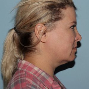 image before myellevate - zoom lift minimally invasive neck lift right angle case 7202