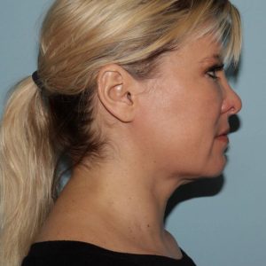 image after myellevate - zoom lift minimally invasive neck lift right angle case 7202