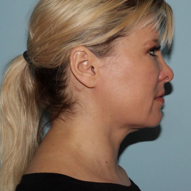 image after myellevate - zoom lift minimally invasive neck lift right angle case 7202