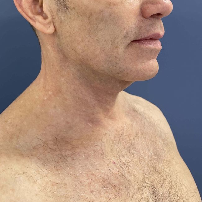 image before myellevate - male adult patient 45 degrees right angle case 6455